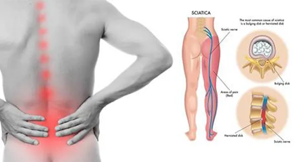 Cây thuốc Nam chữa đau thần kinh tọa