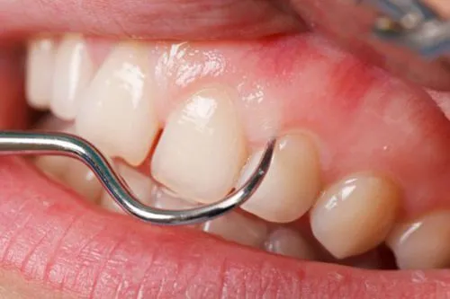 Những điều cần lưu ý khi lấy cao răng