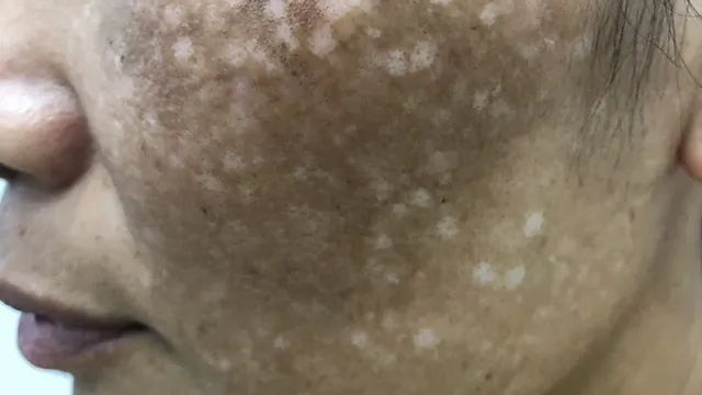 Người phụ nữ sẹo trắng loang lổ vì điều trị rám má sai cách