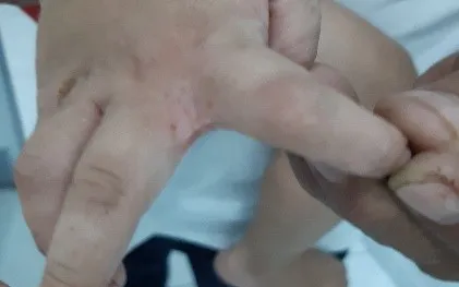 Phòng và điều trị ghẻ ký sinh
