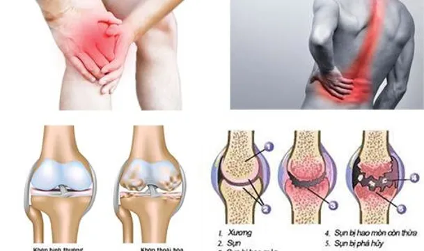 Thực phẩm bảo vệ sức khỏe viên xương khớp An Khớp Xà