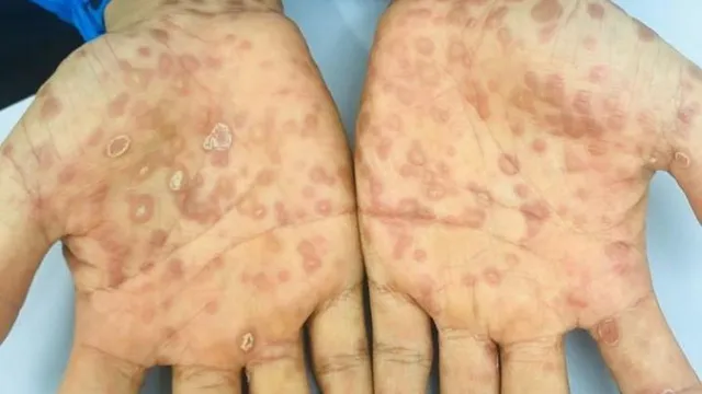 Bệnh giang mai ảnh hưởng tới sức khỏe thế nào?
