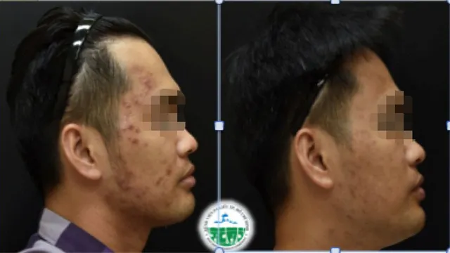 Tăng sắc tố sau viêm: Phòng ngừa và điều trị