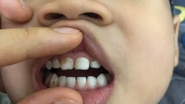 Phòng ngừa sâu răng ở trẻ em