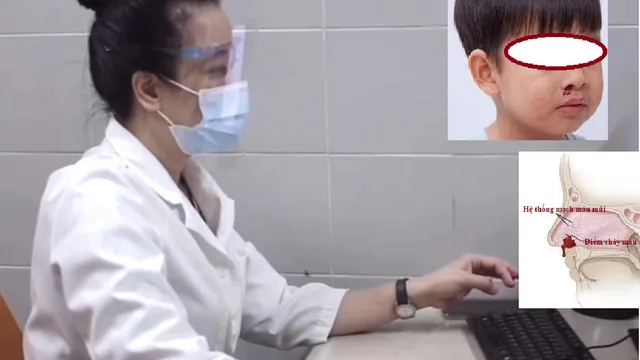 "Trẻ chảy máu mũi mùa đông" - cha mẹ có cần lo lắng hay không?
