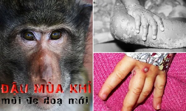 Đậu mùa khỉ - mối đe doạ mới...