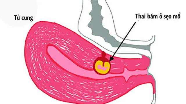 Cẩn trọng với thai bám ở sẹo mổ cũ