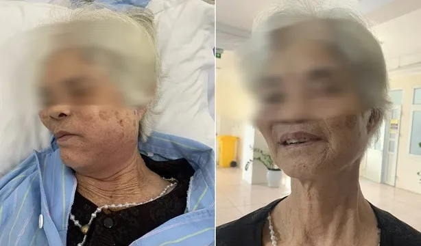 Cẩn trọng nguy cơ nhiễm trùng huyết do viêm mô tế bào vùng hàm mặt