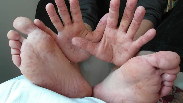 Bệnh tay chân miệng gia tăng phức tạp - Cách phòng tránh và điều trị bệnh
