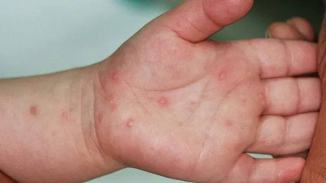 Gia tăng bệnh nhi mắc tay chân miệng ở ĐBSCL