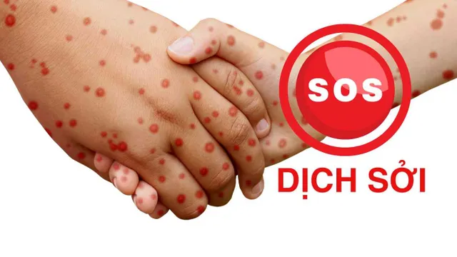 SOS - Dịch sởi