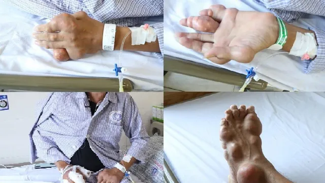 Dấu hiệu cảnh báo cơn gout cấp tái phát và cách phòng ngừa
