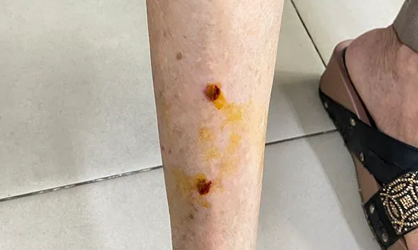 Không dùng các biện pháp dân gian chữa bệnh dại