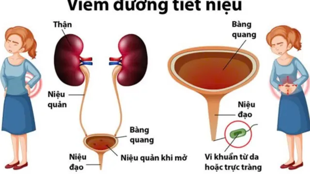 Nhiễm trùng tiết niệu ở phụ nữ tiền mãn kinh: Nguy cơ âm thầm, biến chứng nguy hiểm