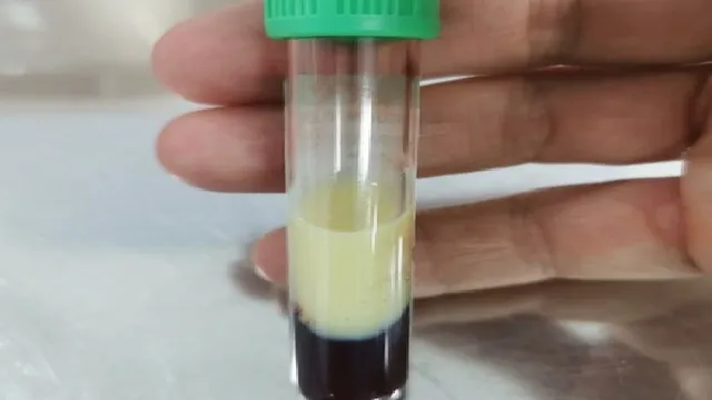 Không tuân thủ điều trị, bệnh nhân nhập viện vì viêm tụy cấp do triglycerid tăng kịch phát