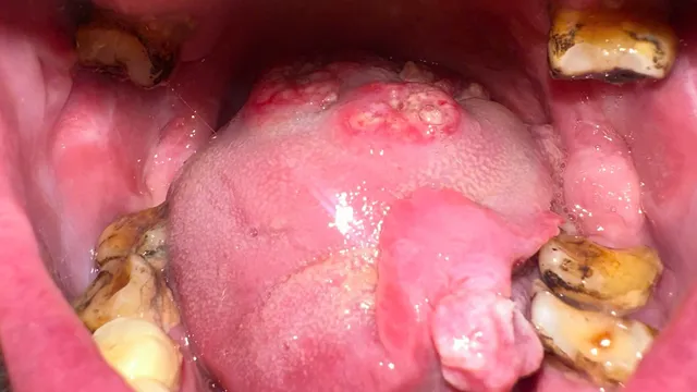Ung thư khoang miệng: Các biểu hiện ban đầu thường gặp
