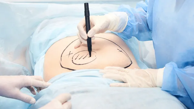 Yêu cầu Bệnh viện Đa khoa Gia Định tạm ngưng phẫu thuật hút mỡ bụng
