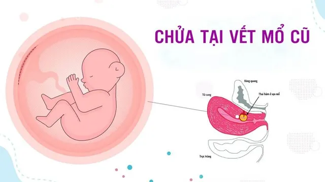 Chửa tại vết mổ cũ: Nguy cơ vỡ tử cung, đe dọa tính mạng