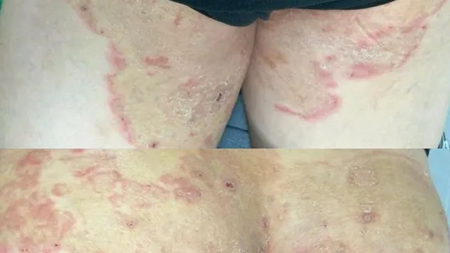 Phát hiện sớm giang mai - nấm da, điều trị đúng để ngăn biến chứng