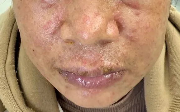 Viêm da nặng, suy thượng thận do mỹ phẩm làm trắng không rõ nguồn gốc