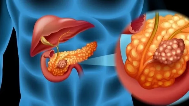 Phát hiện ung thư tụy giai đoạn cuối từ biểu hiện đau bụng kéo dài