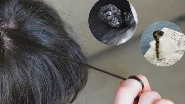 Bé trai 7 tuổi mắc hội chứng Rapunzel do ăn tóc gây tắc ruột