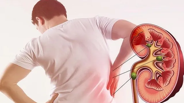 Đừng chủ quan với các cơn đau nghi ngờ liên quan đến thận - tiết niệu