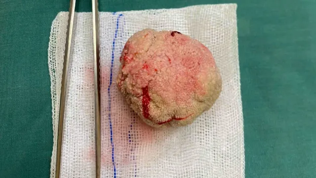 Cụ ông 98 tuổi mang viên sỏi bàng quang to như quả trứng gà
