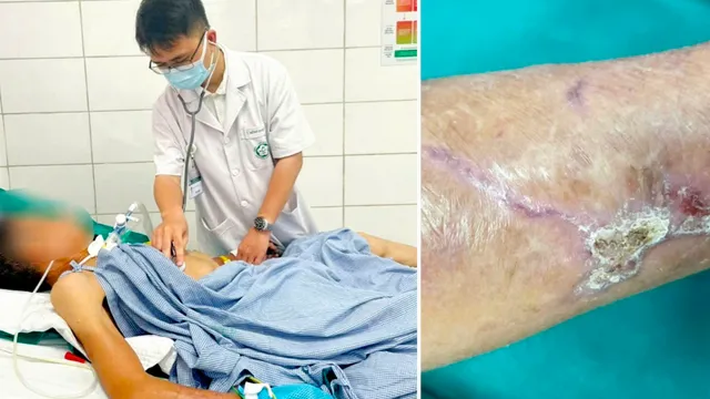 Cảnh báo uốn ván sau vết thương nhỏ