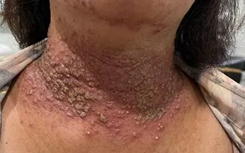 Thoát biến chứng nhờ phát hiện bệnh da hiếm kịp thời