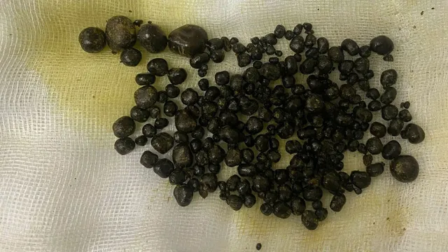 Gần 400 viên sỏi "chen chúc" trong túi mật nữ bệnh nhân 47 tuổi