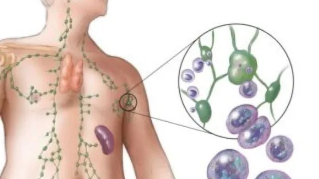 U lympho: Đừng để "kẻ thù thầm lặng" đánh úp bạn