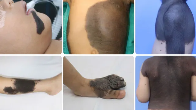 Nơ vi hắc tố bẩm sinh: Đừng xem nhẹ vết bớt của trẻ