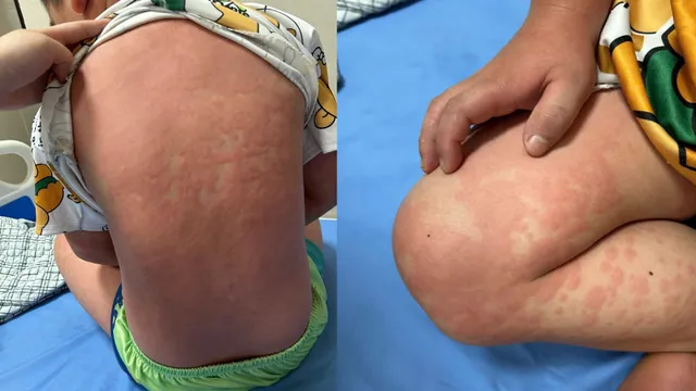 Cảnh báo ban nhiễm trùng ở trẻ: Không nên chủ quan với triệu chứng ngoài da