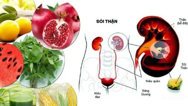 Sỏi thận nên ăn gì để nhanh đào thải?