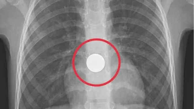 Nguy hiểm từ hóc dị vật: Chủ đề không mới nhưng không thể lơ là