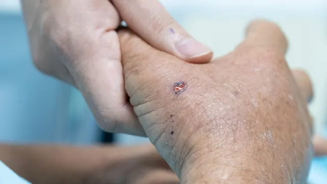 Sống sót kỳ diệu sau khi bị ong vò vẽ đốt hơn 30 vết, hôn mê nguy kịch