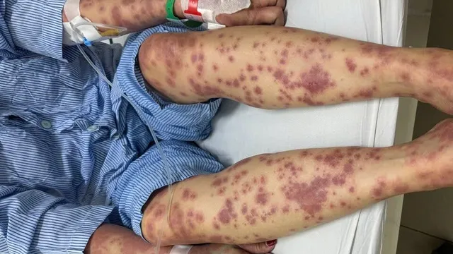 Nguy kịch vì dùng thuốc giảm cân, collagen không rõ nguồn gốc