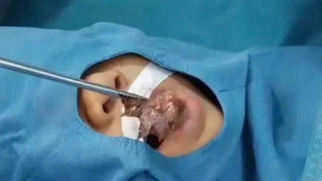 Bé trai 4 tuổi suýt ngạt vì cá rô chui vào cổ họng