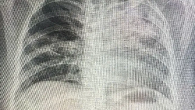 Lao phổi trẻ hóa, nhiều ca phát hiện nhờ X-quang ngực