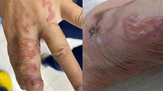 Ăn gỏi cá sống - coi chừng nhiễm giun sán tấn công gan, phổi