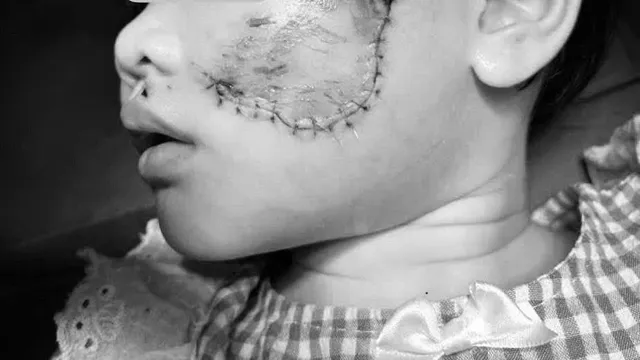 Nguy cơ từ vật nuôi: Nỗi lo từ những vết thương trên mặt trẻ nhỏ