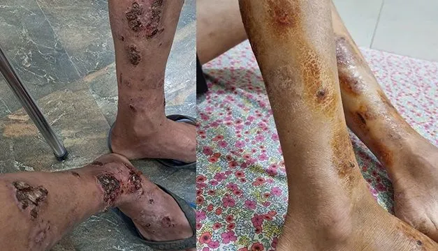 Tự ý đắp thuốc nam, nam sinh bị viêm da nhiễm khuẩn nặng