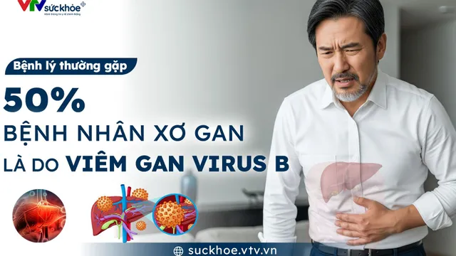 50% bệnh nhân xơ gan là do viêm gan virus B