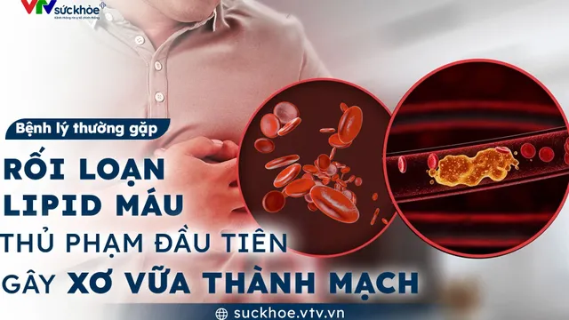 Rối loạn lipid máu - Thủ phạm đầu tiên gây xơ vữa thành mạch