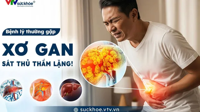 Xơ gan - “sát thủ thầm lặng"!