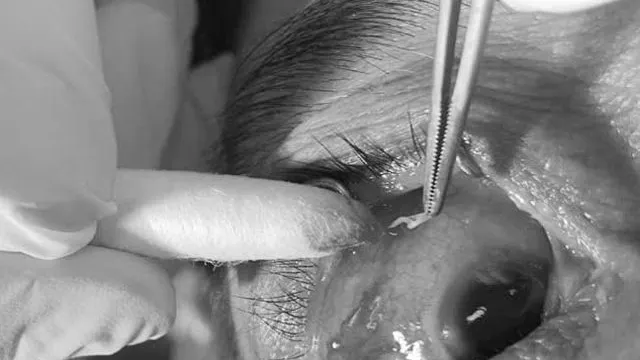 Phát hiện giun đũa chó, mèo ký sinh trong mắt người bệnh