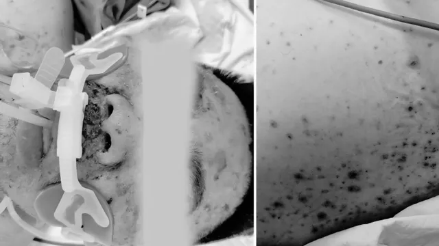Nam thanh niên tử vong do biến chứng thủy đậu, từng không tiêm vaccine