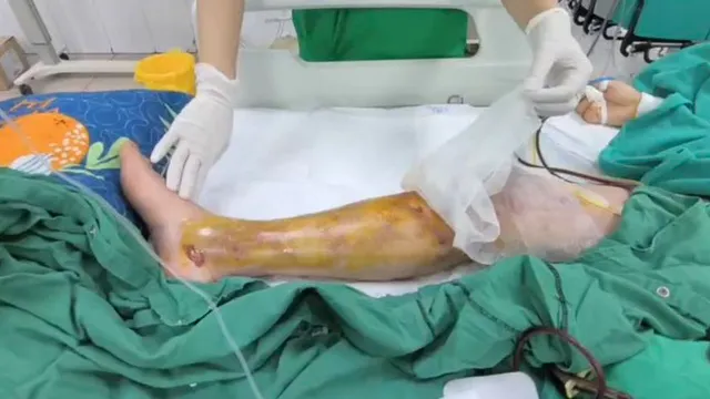Nguy kịch tính mạng vì nhiễm trùng nặng sau vết xước nhỏ ở chân
