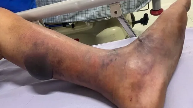 Hà Nội: Số ca mắc sốt xuất huyết và tay chân miệng tăng, ghi nhận ca tử vong do liên cầu lợn